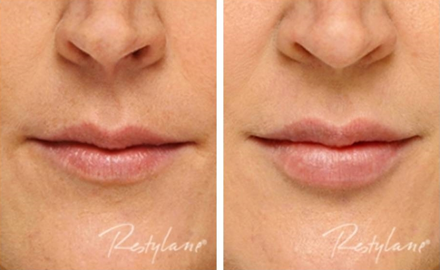 Botox lips before and after 7 months